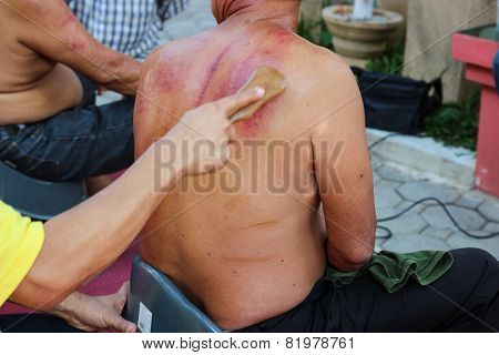 The Teacher Demonstrate Guasa Technique Which Is The Alternative Medicine For Skin Detoxifying On Vo