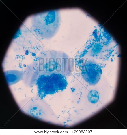 background Blue bacteria in gram stain sputum.