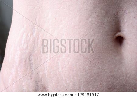 Female belly with stretch marks closeup on a gray background