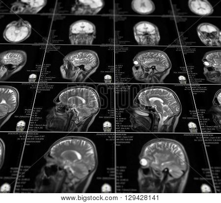 Magnetic resonance imaging of the brain with no visible abnormalities. MRI in different views