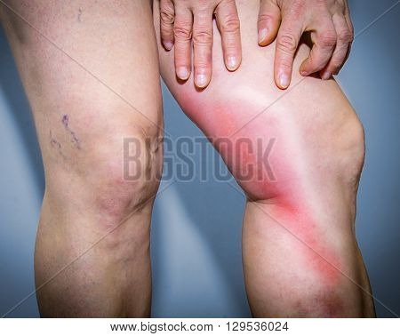 Thrombophlebitis In Human Leg