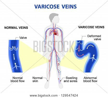 Varicose vein forms in a leg. Normal vein and varicose vein. Vector