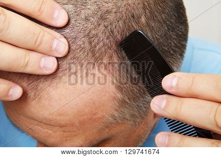 Senior Man And Hair Loss Issue