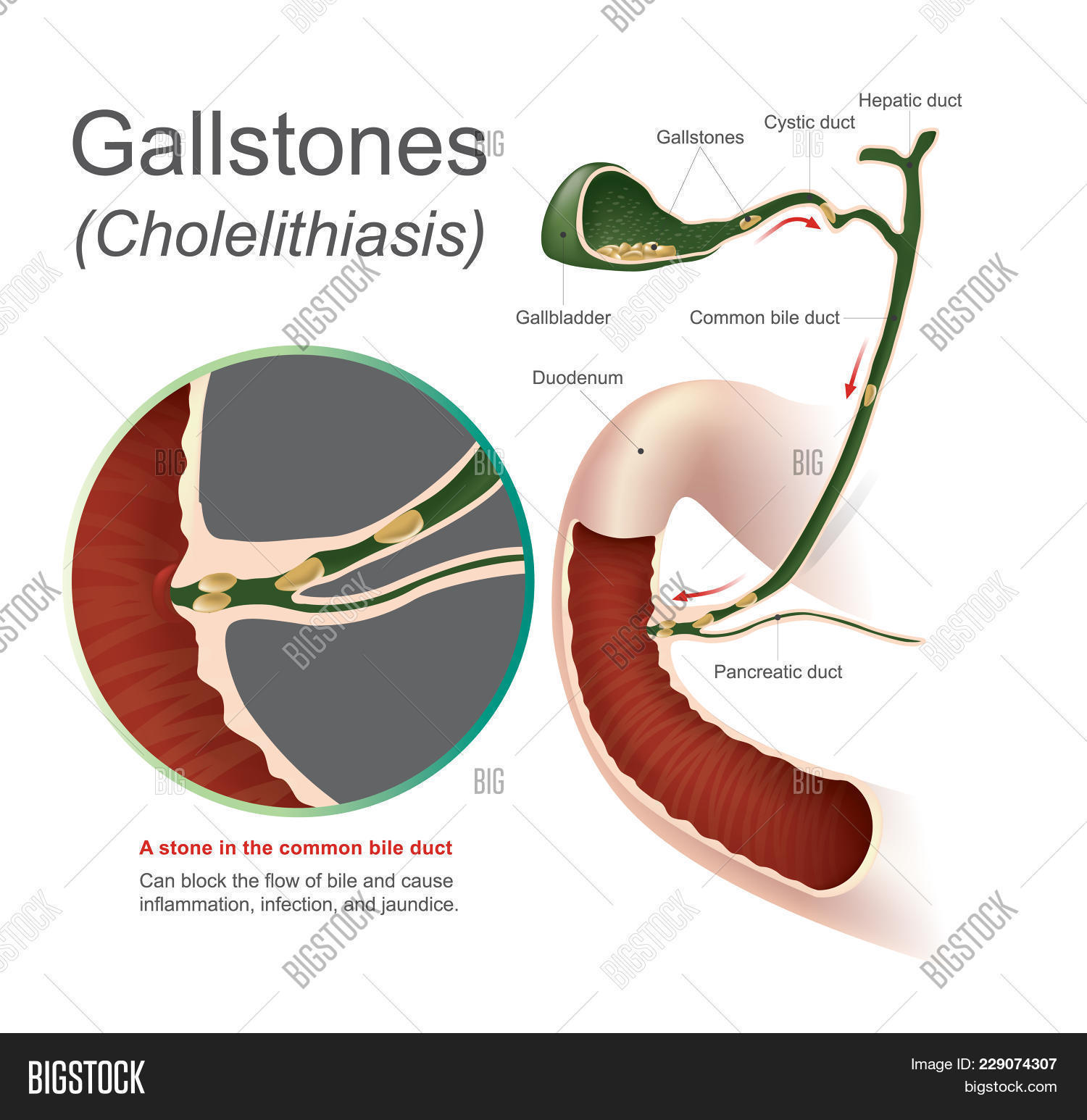 Stone Common Bile Duct Image & Photo (Free Trial) Bigstock