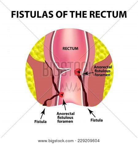 Types Of Fistulas Of The Rectum. Paraproctitis. Anus. Abscess Of The Rectum. Infographics. Vector Il
