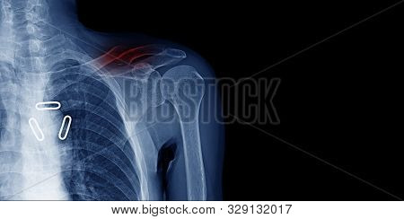 X-ray Image And Banner Design Of Shoulder In Blue Tone With Black Background