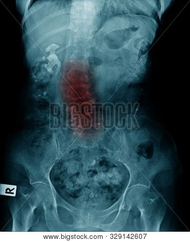 Lumbar Spondylosis And Scoliosis, X-ray Image Ap And Lateral View