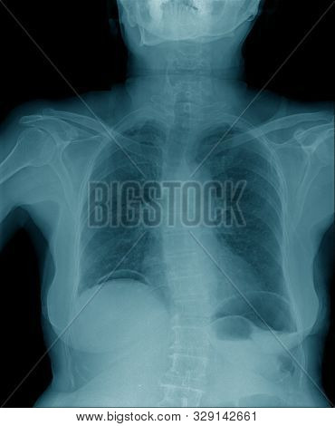 Chest X-ray , Hight Quality Chest X-ray Image In Blue Tone