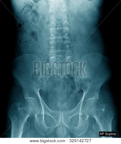 Old Man X-ray, Lumbar X-ray Image With Pelvic Bone In Blue Tone