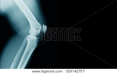 X-ray Image Knee Joint With Banner Design For Webpage And Hight Quality Print