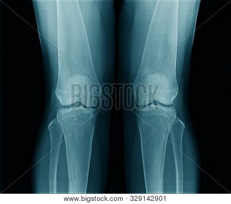 High Quality X-ray Knee Joint Of Old Man, Oa Knee Of Old Man On Black Background In Blue Tone