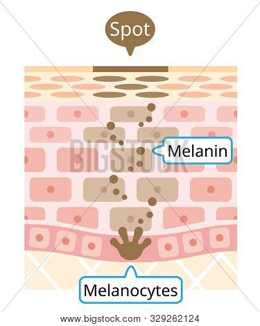 Human Skin Layer Of Melanin And Facial Dark Spots. Infographic Skin Layer Illustration