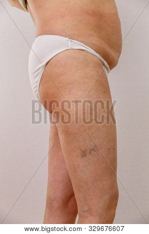 Elderly Woman In White Panties Shows Cellulite And Varicose Veins On A Light Isolated Background. Co