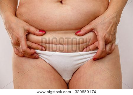 An Elderly Woman Lowers Her Underwear And Shows The Scar From The Operation