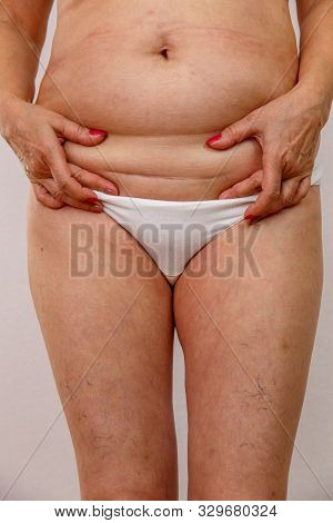 An Elderly Woman Lowers Her Underwear And Shows The Scar From The Operation