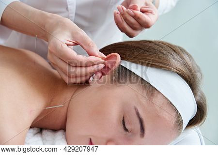 Beautiful Woman Relaxing On A Bed Having Acupuncture Treatment With Needles In And Around Her Ear. A