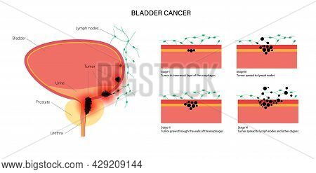 Bladder Cancer Stages Anatomical Poster. Bladder, Urethra, Lymph Nodes And Prostate In Male Body. In
