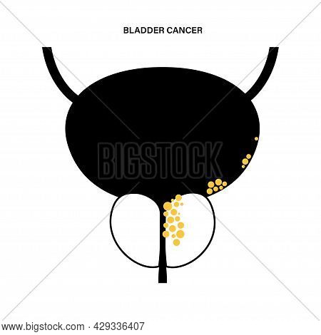 Bladder Cancer Icon. Stones In Bladder, Urethra, Lymph Nodes And Prostate In Male Body. Inflammation
