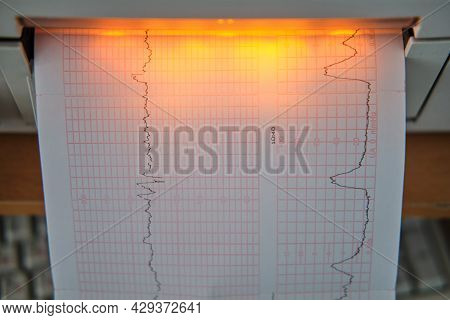 Ctg Device With Monitoring Of The State Of Health Of The Mother And Child During Childbirth In The H