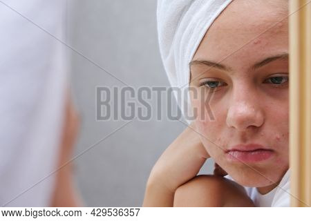 A Sad Teenage Girl Is Looking At The Pimples On Her Face In The Mirror. Problematic Skin In Adolesce