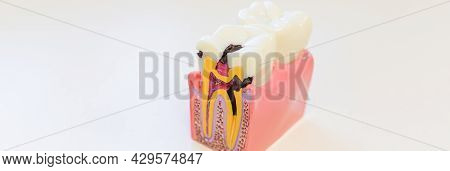 Dental Decay Model Shows Progress Of Decay.an Example Of Dental Disease. Dentistry. Caries On The To