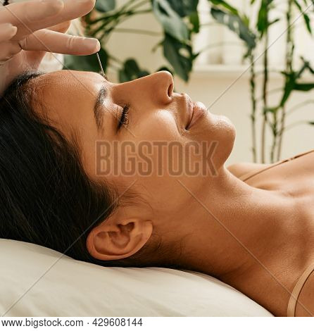 Acupuncture Treatment For Migraines And Headaches. Close-up Of Reflexologist Hand With Acupuncture N