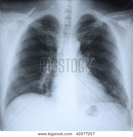Lungs, X-ray Shot