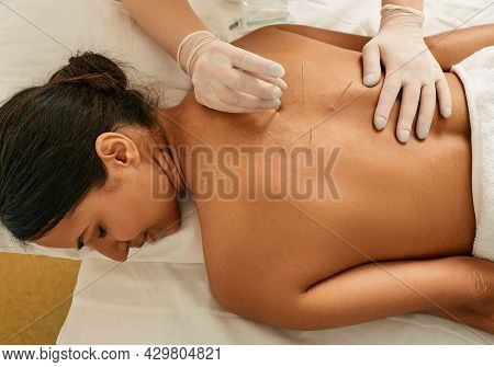 Acupuncture For A Back Of A Young Woman In A Chinese Clinic. View From Above