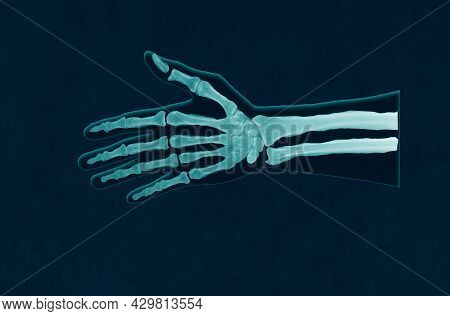 Simulate X-ray Hand And Wrist Jiont Showing Normal X-ray