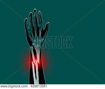 Film X-ray Forearm Simulating Photography Finding Fracture At Left Ulnar And Left Radial Diaphysis W