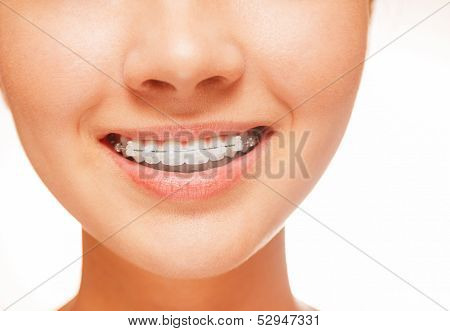 Braces On Teeth, Close-up