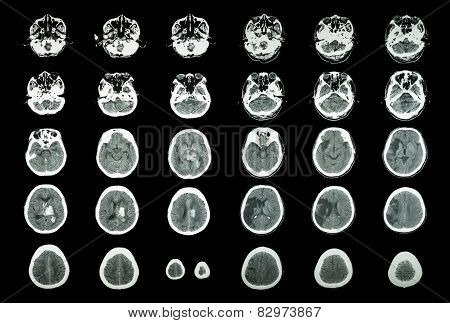 Hemorrhagic Stroke And Ischemic Stroke