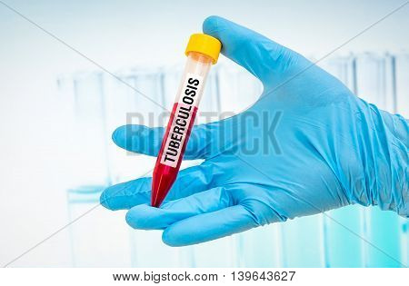 Test-tube With Blood Sample For Tuberculosis Test