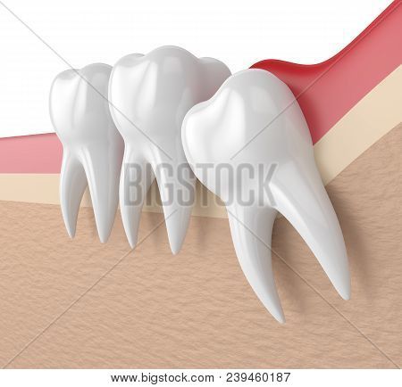 3D Render Of  Wisdom Mesial Impaction With Pericoronitis