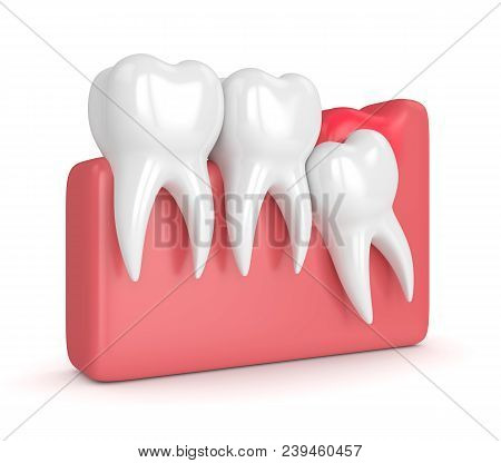 3D Render Of  Wisdom Mesial Impaction With Pericoronitis