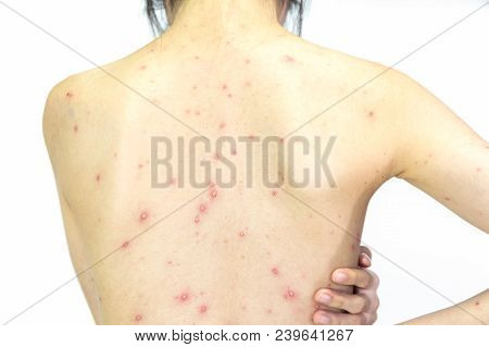 Closeup Of Girl Back Of Blisters, Scar And Rash Caused By Varicella Virus Or Chicken Pox On White Ba