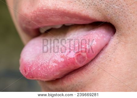 Tongue With Ulcers Of An Adult Man