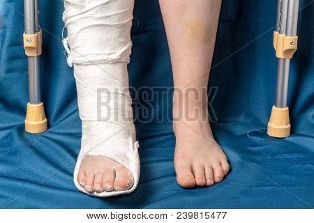 Leg Fracture In Gypsum And Crutches, Close Up Only Legs, One With Plaster And Other Leg With Bruises