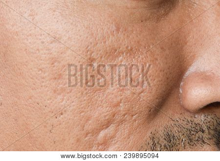The Cheek Of Men With Facial Problems. Acne Scars,large Pores,pimple, Comedone,oily And Dull Skin.th