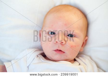 Allergies, Atopic Dermatitis On The Face Of A Baby