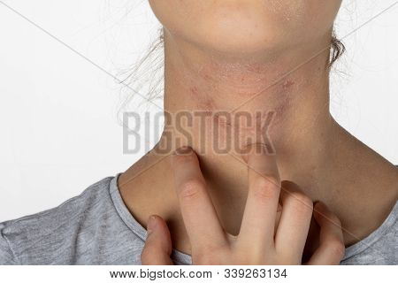 Allergic Itchy Skin On Girl Neck. Teen With Rash Dry Skin Scratching Her Neck. Dermatological Proble