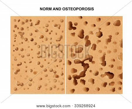 Illustration Of The Process Of Osteoporosis. Bone.