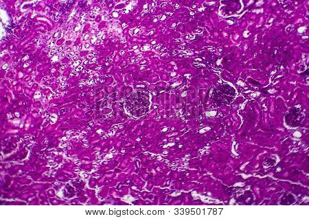 Histopathology Of Acute Nephritis, Light Micrograph, Photo Under Microscope