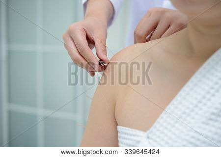 Electro Acupuncture.traditional Chinese Acupuncture And Electroacupuncture On Body Of Patient
