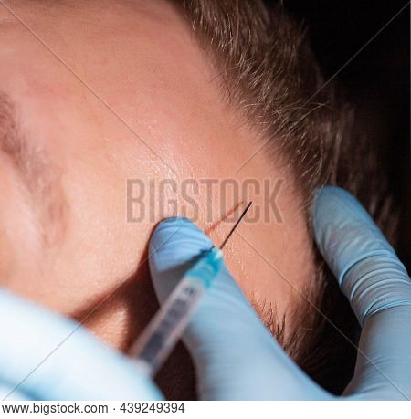 The Doctor Makes An Injection Of Allopathic Mesotherapy Of Hair Of The Skin On The Head Of A Man. Ba