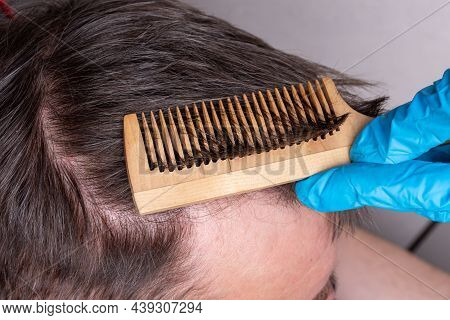 Human Baldness Or Hair Loss - A Doctor In Blue Medical Gloves Examines The Hair And Scalp Of A Man, 