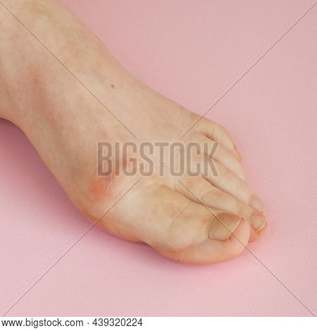 Woman's Hand Massaging Her Bunion Toes In Bare Feet To Relieve Pain On Pink Background Woman Feet Pr