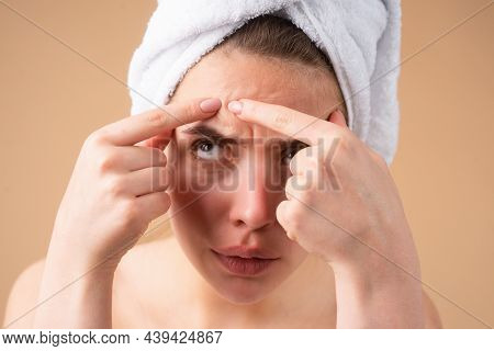 Close Up Woman Squeezing Pimples On Her Face. Acne Blemish Spots Skin On Young Woman. Spot Scar Acne