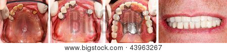 Upper Prosthesis Step By Step
