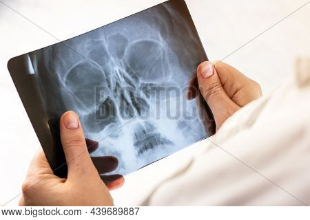 Magnetic Resonance Scan Of A Human Brain With Skull In Doctor Hands. Mri Head Scanning On Light Back